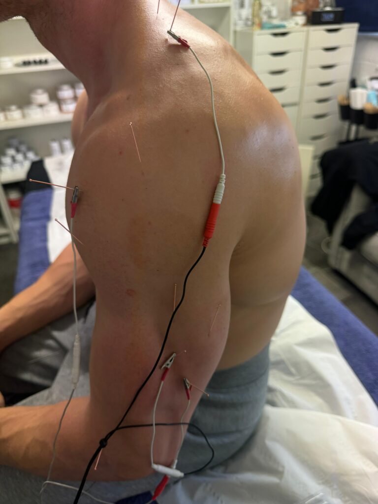 lgbt acupuncture session manchester